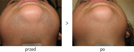 Laserowe usuwanie włosów z brody i szyi - efekt przed i po
