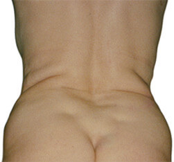 Efekt eliminacji tkanki tłuszczowej z bioder i pośladków - przed zabiegiem Lipomassage