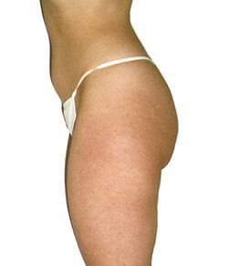 Efekt eliminacji tkanki tłuszczowej z pośladków, ud i brzucha - po zabiegu Lipomassage