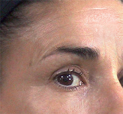 Zabieg kosmetyczny Endermolift na twarz - efekt po