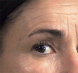 Zabieg kosmetyczny Endermolift na twarz - przed zabiegiem