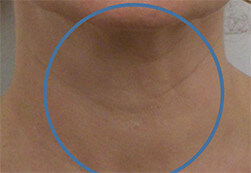 Efekt zabiegu Voluderm Legend ujędrniającego skórę - szyja kobiety po zabiegu