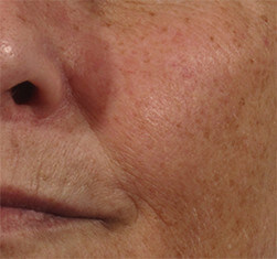 Efekty zabiegu geneO - rozjaśnienie i odżywienie skóry twarzy - efekt przed