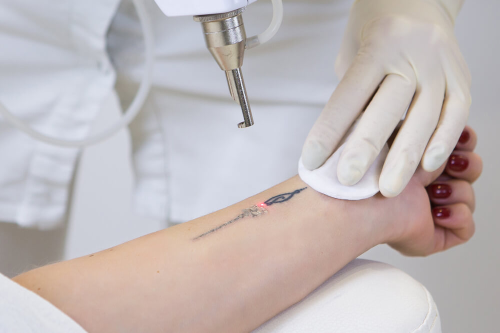 Laserowe usuwanie tatuażu w klinice urody