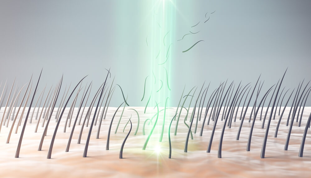 czy depilacja laserowa rozwiaze problem czy depilacja laserowa rozwiaze problem